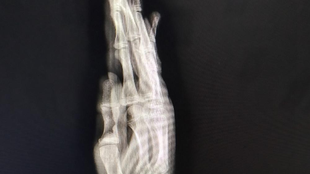 X-ray of a Broken Hand Radiography wallpaper