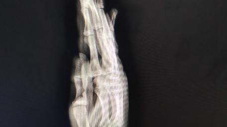 X-ray of a Broken Hand Radiography wallpaper